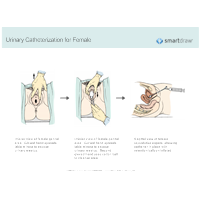 Urinary Catheterization for Female