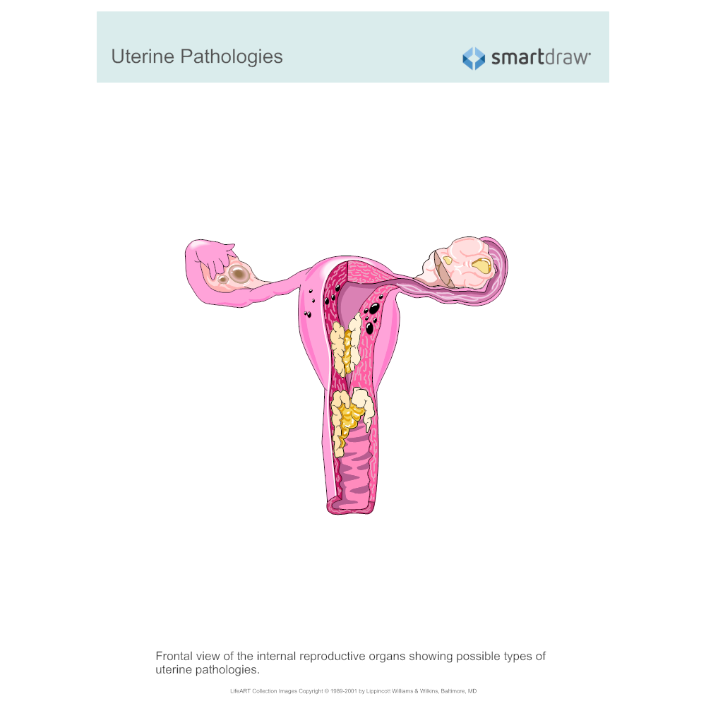 Example Image: Uterine Pathologies