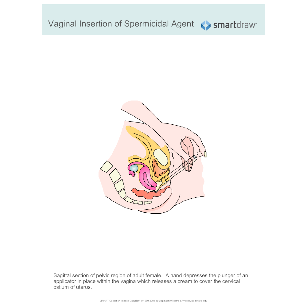 Example Image: Vaginal Insertion of Spermicidal Agent
