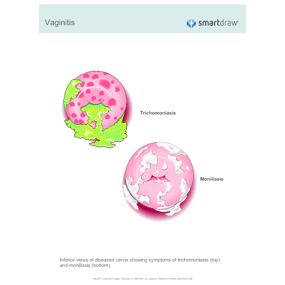 Example Image: Vaginitis