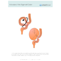 Volvulus of the Sigmoid Colon